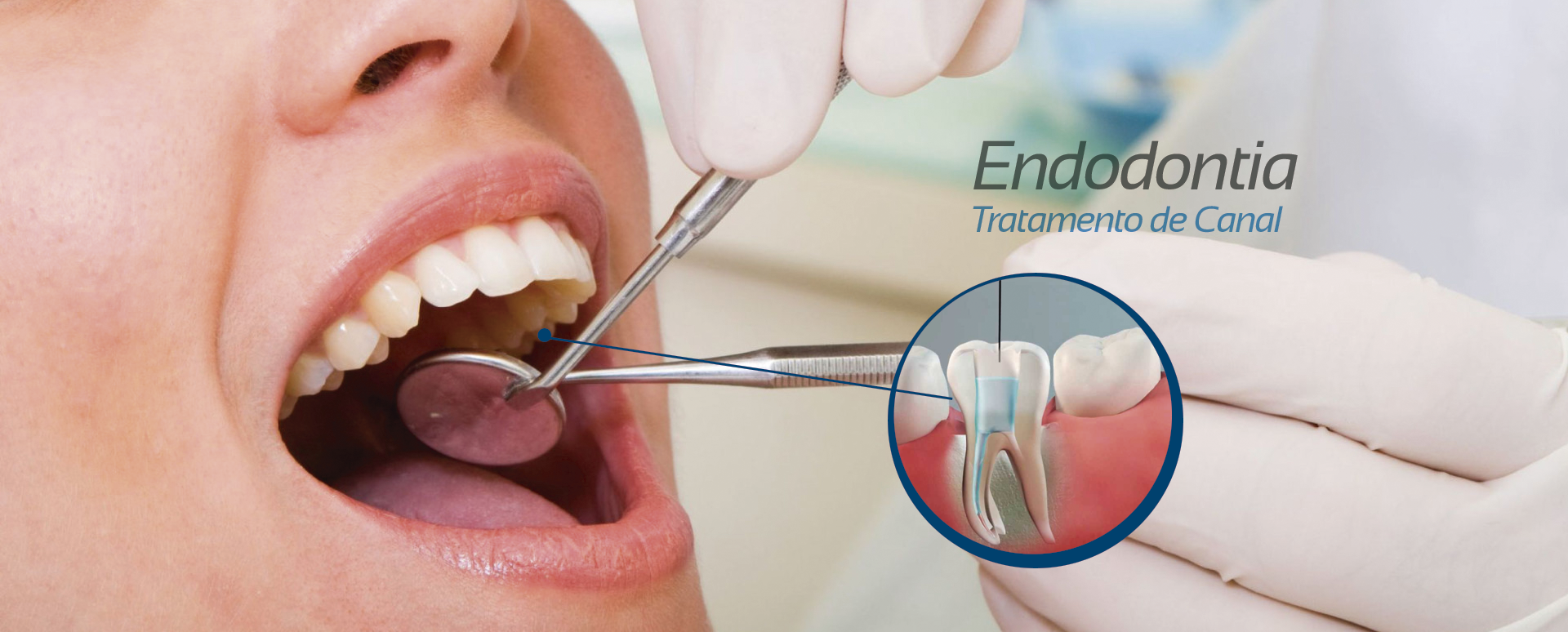 Endodontia/Tratamento de canal